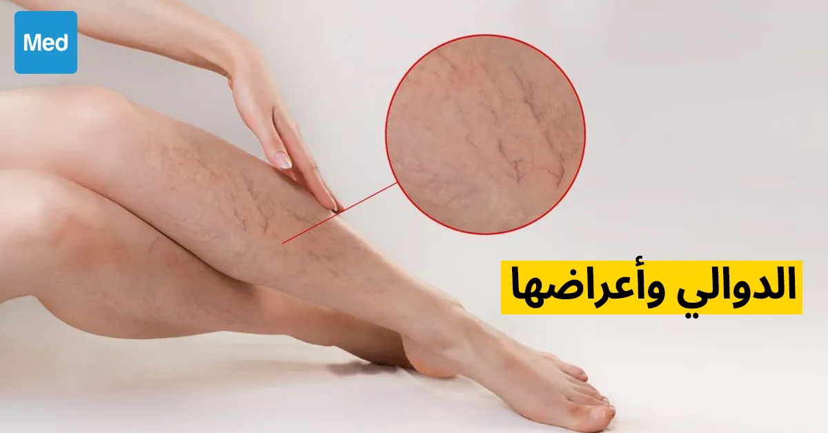 الدوالي وأعراضها